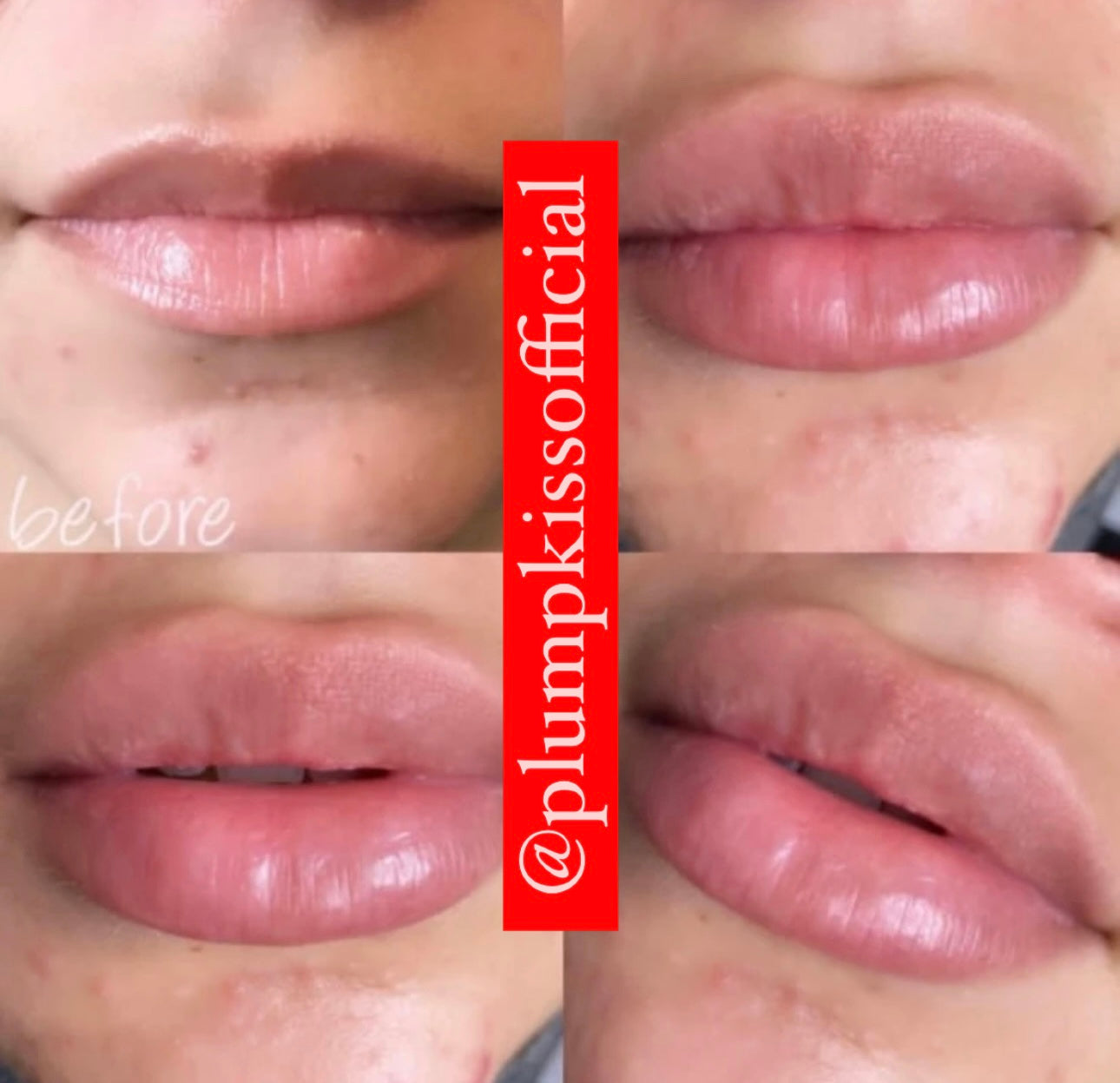 💋 NO NEEDLE LIP PLUMPER GLOSS