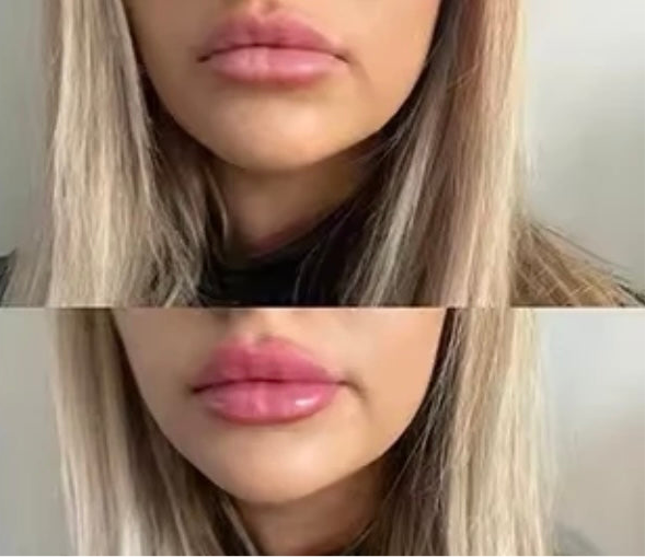 💋 NO NEEDLE LIP PLUMPER GLOSS