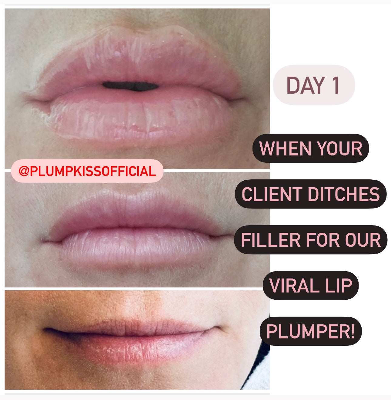 💋 NO NEEDLE LIP PLUMPER GLOSS